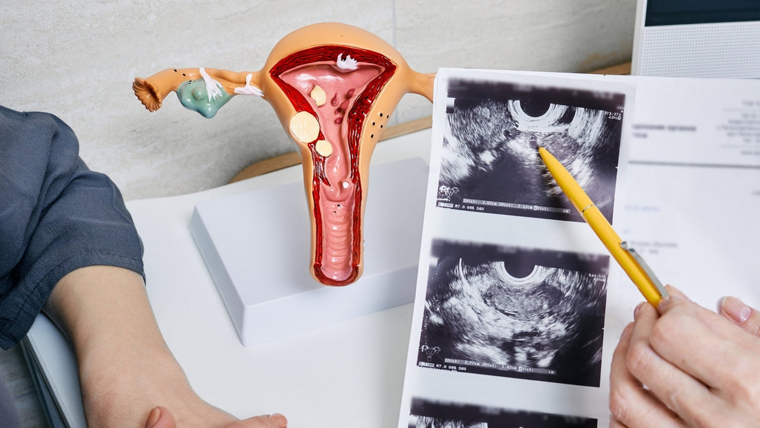 Cáncer de ovario: información clave para su detección y tratamiento