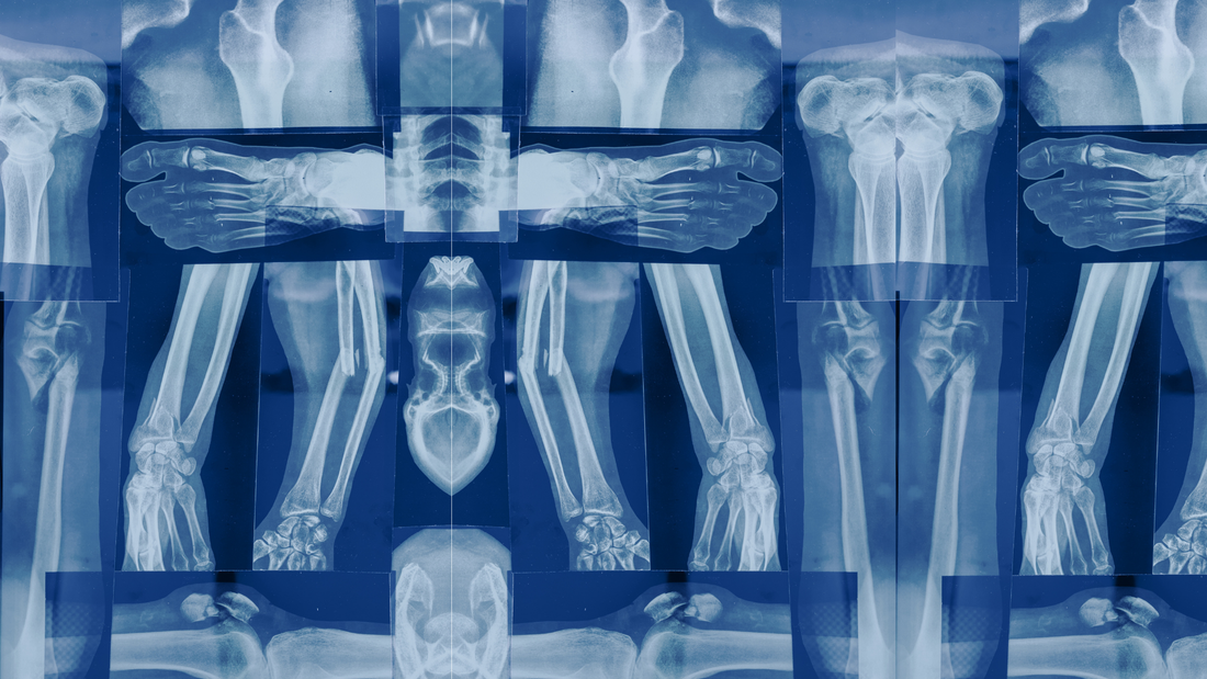 Osteoporosis y riesgo de fracturas: Importancia de la atención oportuna