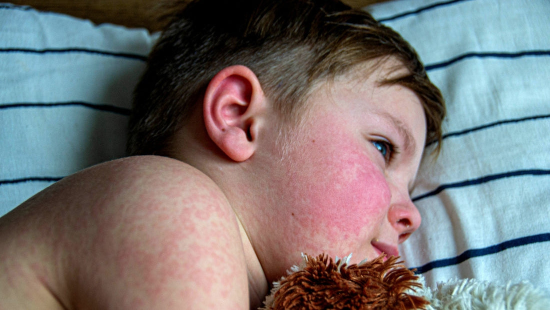 Sarampión: síntomas clave y cuándo buscar atención médica