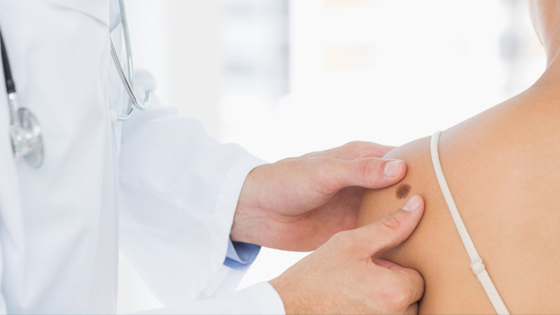 Melanoma Cutáneo: Prevención y Diagnóstico