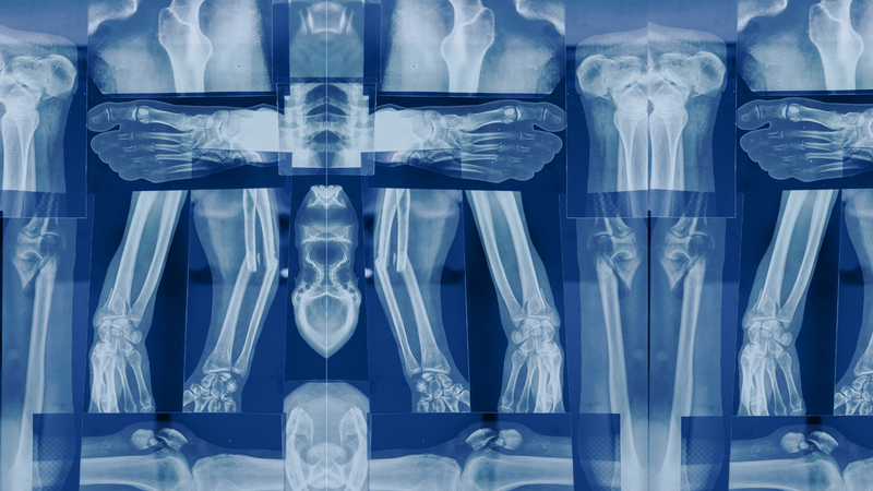 Osteoporosis y riesgo de fracturas: Importancia de la atención oportuna