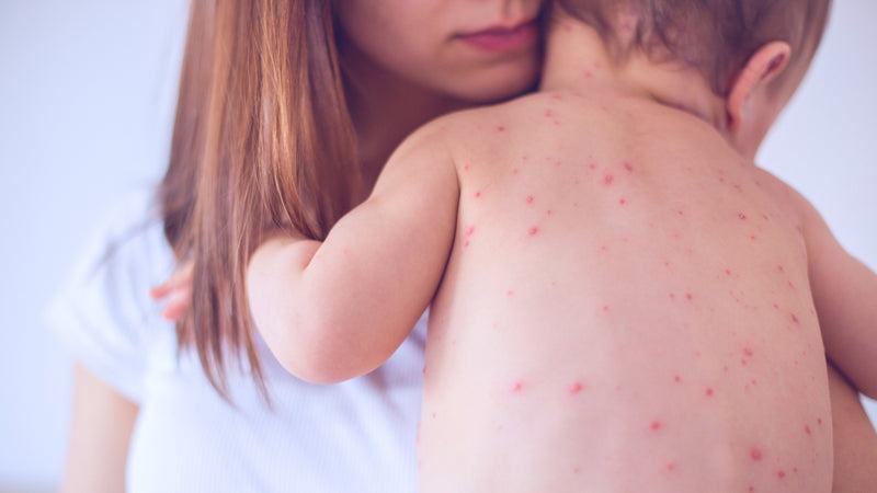 Vacuna Contra la Varicela: Accede a Protección Segura y Confiable