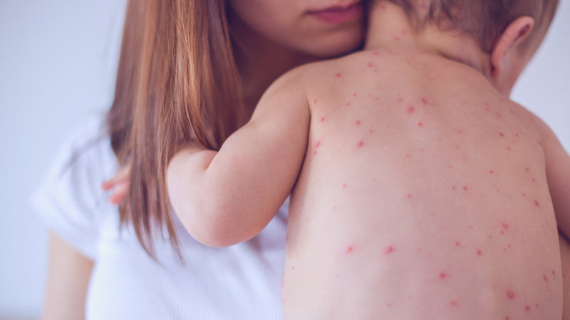 Sarampión: Importancia y Mitos Comunes